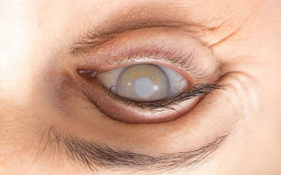 Katarakt Tedavisinde Femtosaniye Lazer Yöntemi