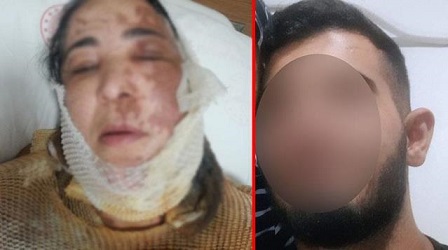  bir kişi, babasından boşanan üvey annesini üzerine kezzap dökerek ağır şekilde yaraladı.