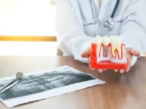 Finansman kolaylıklarıyla implant tedavilerine talep artıyor